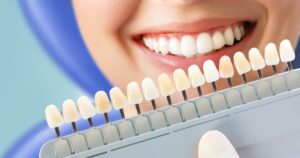 Nubeam Teeth Whitening Product: Before and After Guide